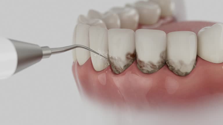 Trusted Wisdom Tooth Removal service in Pismo Beach, CA - Dentist Open Now